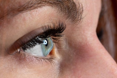 Menschliches Auge einer Frau, die an Keratokonus oder konischer Hornhaut erkrankt ist. Sehstörungen, die zu Kurzsichtigkeit und Astigmatismus und schweren Sehstörungen führen. Behandelbar mit Hornhautvernetzung, Iontophorese oder Hornhauttransplantation.