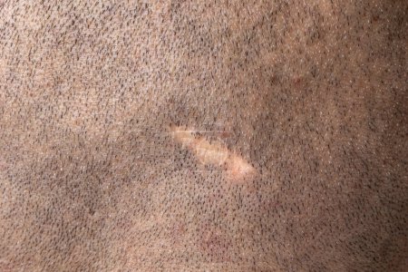Téléchargez les photos : Macro d'une cicatrice sur le cuir chevelu d'un homme aux cheveux rasés. Concept de chirurgie et tissu cicatriciel. Opération sur la tête d'un homme adulte. - en image libre de droit
