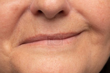 Photo for Close-up of a woman's mouth smiling. Evident asymmetry of the lips due to a hemiparesis of the face. Case of Bell's palsy caused by inflammation of the facial nerve. Paresis from cold snap - Royalty Free Image