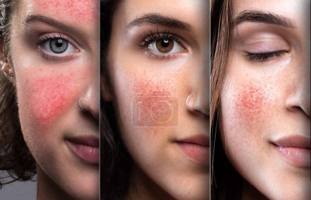 Half faces of girls suffering from rosacea or couperose. Red cheeks and nose from irritated capillaries. Laser treatment concept to reduce redness and inflammation of the skin.