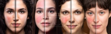 Foto de Collage de rostros de mujeres que muestran antes y después del tratamiento con láser para la rosácea. Mitad de caras con y sin piel enrojecida debido a la cuperosa - Imagen libre de derechos
