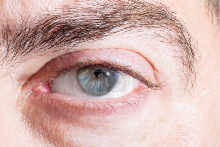 Foto de Macro de un ojo humano masculino con una pupila irregular y dentada después de una cirugía de lentes debido a uveítis. Fenómeno de la iritis vino iridociclitis - Imagen libre de derechos
