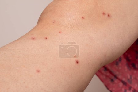 Photo for Residual chicken pox symptoms on a woman's leg. Red scabs caused by pustules caused by the Herpes zoster virus, a possible cause of shingles - Royalty Free Image