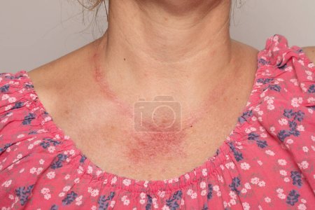 Reacción alérgica en el cuello de una mujer. Enrojecimiento generalizado en la piel de una dama con collares de metal. Concepto de eritema para la alergia al níquel o al cromo de bisutería