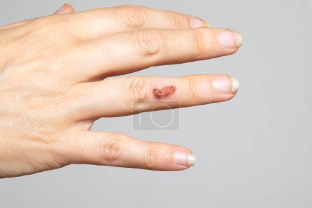 Photo for Female hand with a scab due to impetigo, a contagious bacterial infection that causes skin lesions caused by Staphylococcus aureus and Streptococcus pyogenes - Royalty Free Image