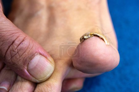 Ongle orteil avec onychomycose vue du bas. Infection fongique qui infecte la kératine. Mycose commune du pied humain