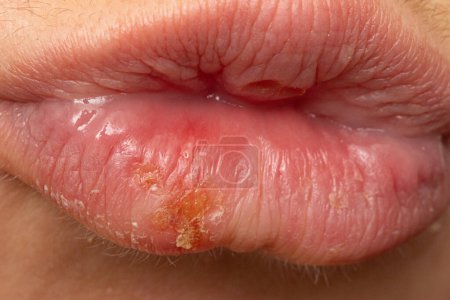Photo for Macro of woman's lips with cold sores. Herpes simplex pustules close-up in a female mouth. - Royalty Free Image