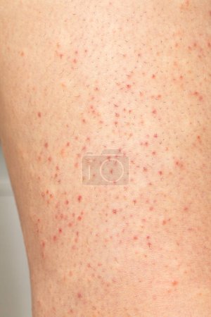 Photo for Macro of skin with folliculitis. Closeup of woman hair with irritation of the hair bulbs. Localized redness with pinpoint spots. - Royalty Free Image