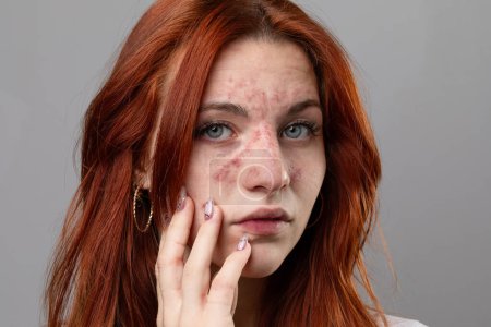 Junge Frau mit akutem Hautausschlag im Gesicht. Dermatologische Probleme aufgrund von Allergien, Überempfindlichkeit oder anaphylaktischem Schock. Rote Haut mit Hautausschlag oder Ekzemen