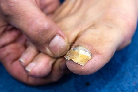 Macro de una uña humana con infección fúngica. Dedo grande con onicomicosis avanzada. Primer plano del pie y la mano analizando las uñas con micosis crónica