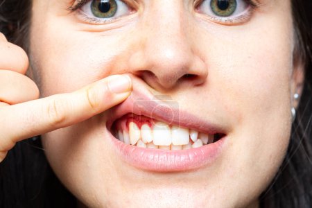 Nahaufnahme eines Mädchens mit blutendem Zahnfleisch, das ihre Lippe mit dem Finger hebt. Makro des Mundes einer Frau mit rotem Zahnfleisch. Entzündung durch Zahnfleischentzündung