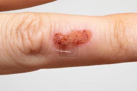 Photo for Female hand with a scab due to impetigo, a contagious bacterial infection that causes skin lesions caused by Staphylococcus aureus and Streptococcus pyogenes - Royalty Free Image