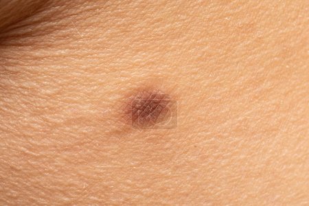 Foto de Macro de una queratosis seborreica marrón, un crecimiento común de la piel no cancerosa (benigna) en la piel caucásica. - Imagen libre de derechos