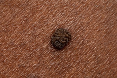 Foto de Macro de una queratosis seborreica marrón, un crecimiento común de la piel no cancerosa (benigna) en la piel africana. - Imagen libre de derechos