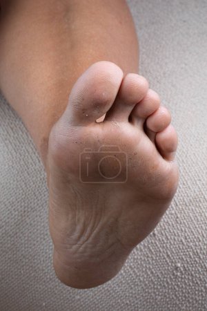 The sole of a bare foot with calluses over a textured fabric, captured in a high-detail shot
