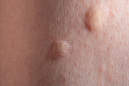 Téléchargez les photos : Plan macro mettant en évidence deux piqûres de moustiques à la surface de la peau, avec la zone environnante légèrement surélevée et rougie en raison de la réaction - en image libre de droit