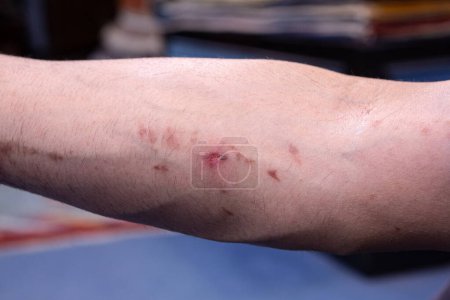 An arm showing the harsh reality of acid burn scars, a testament to pain and healing