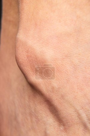Detailed view of a bone spur, an osteophyte on the skin