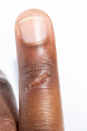 Ein Makro-Shot zeigt die Details eines heilenden Schorfes am Finger, der Textur und Pflege der Haut hervorhebt