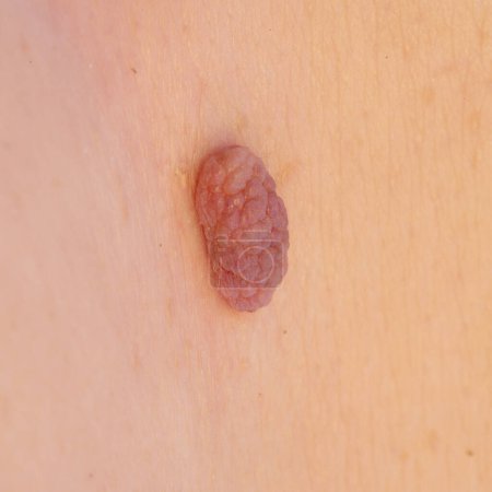 Detailed close-up view of a benign skin tumor on clear skin