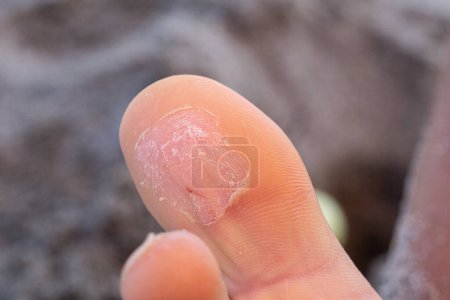 Herangezoomt in den Blick eines menschlichen Fingers, der eine heilende Blase zeigt