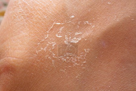 Makroaufnahme trockener menschlicher Haut beim Schuppen und Schälen an der Oberfläche