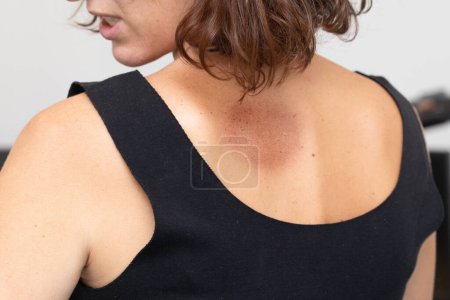 Over-the-shoulder view of a woman showing dermatological spots on her skin, indicating a potential skin condition