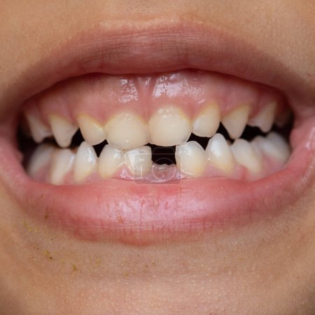 Close-up of a child's open mouth showing a gap from a lost baby tooth, symbolizing growth