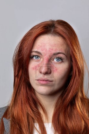 Foto de Mujer caucásica joven que sufre de rosácea facial. Enrojecimiento evidente en la cara debido a la cuperosa que causa dilatación de los capilares - Imagen libre de derechos