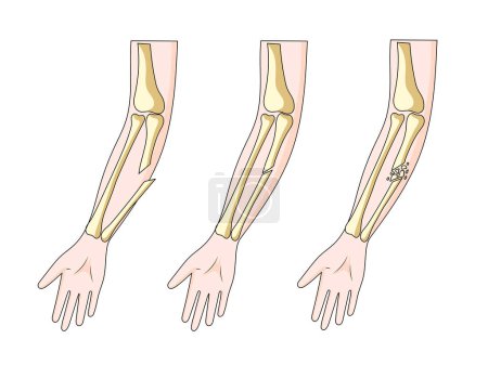 Foto de Tipos de fracturas de hueso de la mano diagrama esquemático raster ilustración. Ilustración educativa de ciencias médicas - Imagen libre de derechos