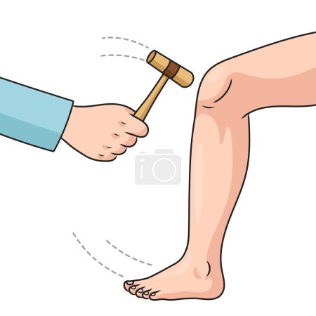 Photo for The doctor checks patellar reflex with a hammer diagram schematic raster illustration. Medical science educational illustration - Royalty Free Image
