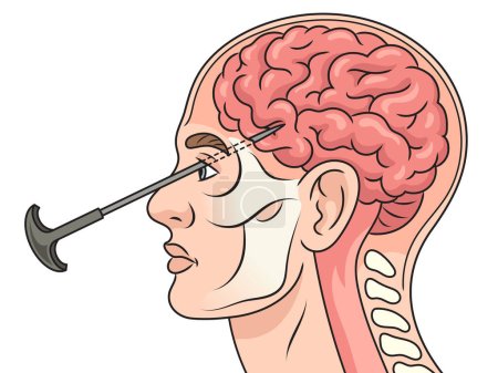 Lobotomía leucotomía tratamiento neuroquirúrgico en esquema de diagrama cerebral ilustración raster. Ilustración educativa de ciencias médicas