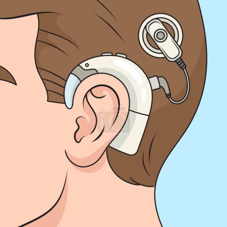 Photo for Cochlear implant on human head diagram schematic raster illustration. Medical science educational illustration - Royalty Free Image