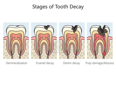 La carie carie dentaire étapes diagramme schématique illustration raster. Illustration pédagogique en sciences médicales