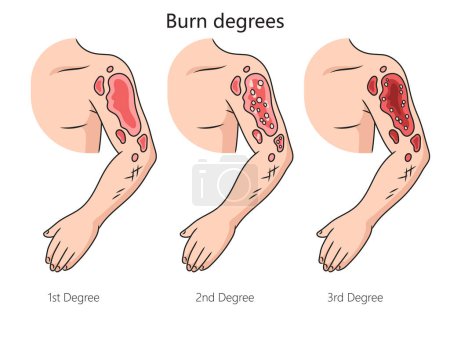 Burn degree diagram schematic raster illustration. Medical science educational illustration