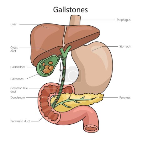 Gallstone stone formed within gallbladder from precipitated bile structure diagram schematic raster illustration. Medical science educational illustration