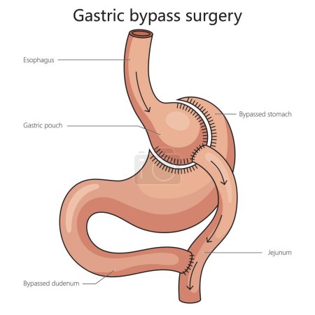 Téléchargez les photos : La chirurgie de pontage gastrique de l'estomac est un diagramme divisé illustration schématique raster. Illustration pédagogique en sciences médicales - en image libre de droit