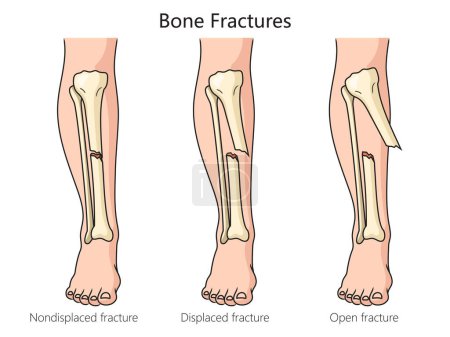 Foto de Tipos de fracturas óseas diagrama esquemático raster ilustración. Ilustración educativa de ciencias médicas - Imagen libre de derechos