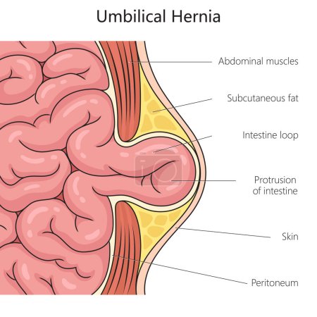 Umbilical hernia structure scheme diagram schematic raster illustration. Medical science educational illustration