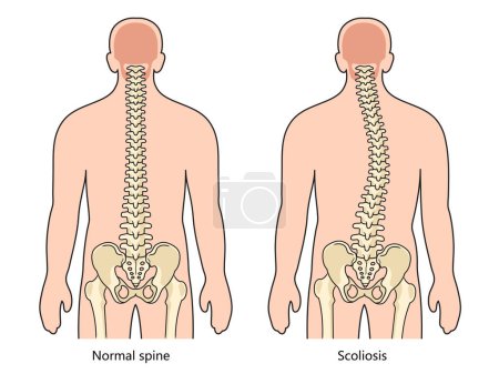 scoliosis structure scheme diagram schematic raster illustration. Medical science educational illustration