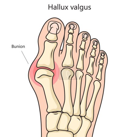 Hallux valgus bunion structure vertebral column diagram schematic raster illustration. Medical science educational illustration
