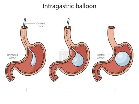 Photo for Intragastric stomach balloon structure diagram hand drawn schematic raster illustration. Medical science educational illustration - Royalty Free Image