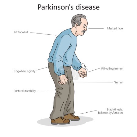 Téléchargez les photos : Homme patient avec diagramme de la maladie de Parkinson illustration schématique raster dessinée à la main. Illustration pédagogique en sciences médicales - en image libre de droit