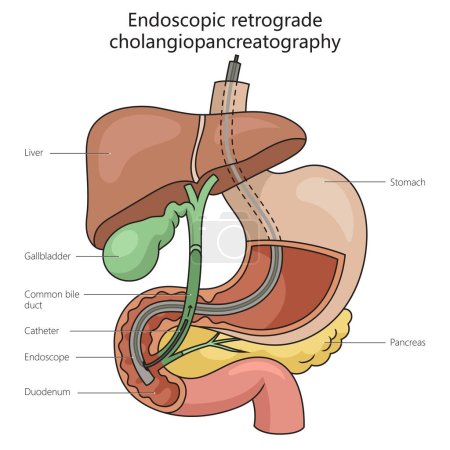 Endoscopic retrograde cholangiopancreatography structure vertebral column diagram hand drawn schematic raster illustration. Medical science educational illustration