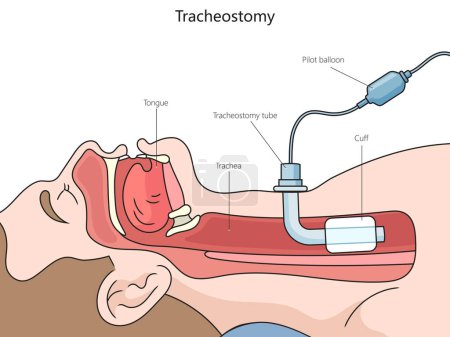Tracheotomy tube structure vertebral column diagram hand drawn schematic raster illustration. Medical science educational illustration