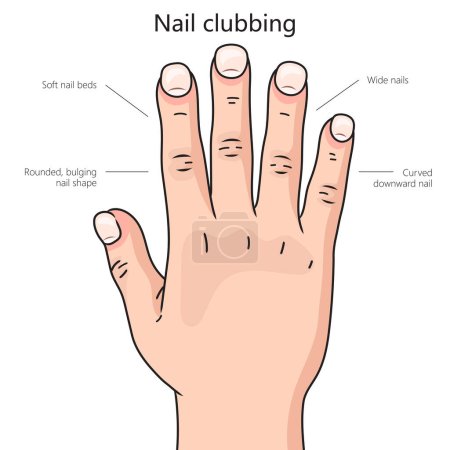 Photo for Nail clubbing diagram hand drawn schematic raster illustration. Medical science educational illustration - Royalty Free Image