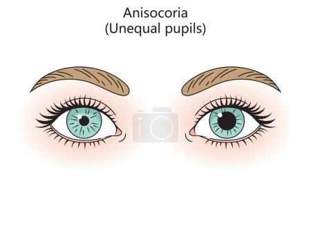 Photo for Human eyes with anisocoria diagram hand drawn schematic raster illustration. Medical science educational illustration - Royalty Free Image