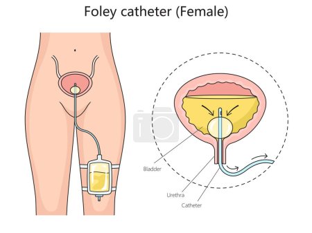 Woman foley urinary catheter structure diagram hand drawn schematic raster illustration. Medical science educational illustration