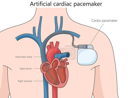 Artificial cardiac pacemaker medical device structure diagram hand drawn schematic raster illustration. Medical science educational illustration