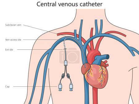 Central venous catheter structure diagram hand drawn schematic raster illustration. Medical science educational illustration